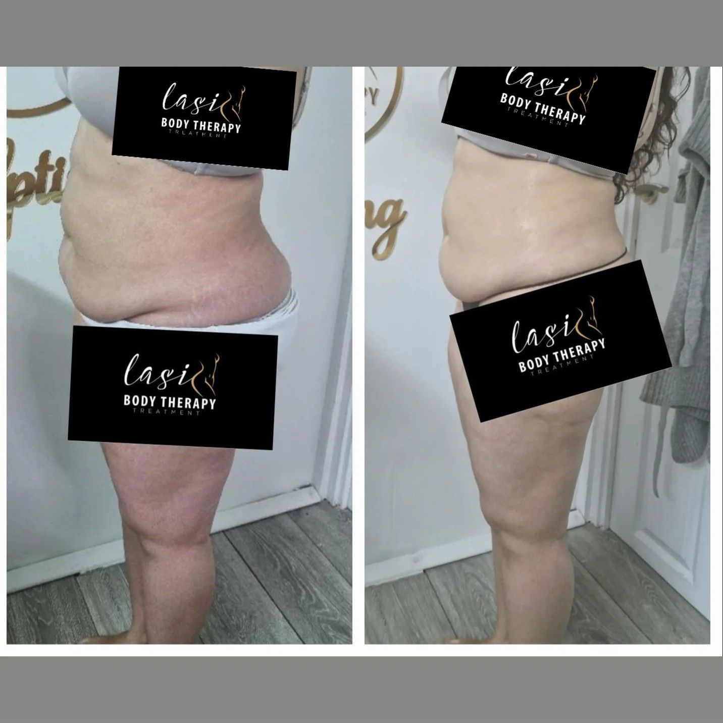 lipo-cavitation treatment result